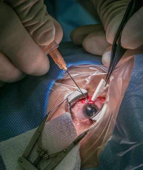 Glaucoma Surgery Training - caotacademy