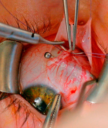 Strabismus Surgery Training - caotacademy